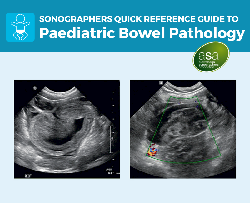 New Poster Resource: Paediatric Bowel Pathology